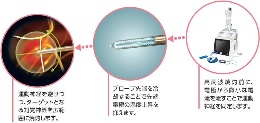 高周波焼灼前に、電極から微小な電流を流すことで運動神経を同定します。→プローブ先端を冷却することで先端電極の温度上昇を抑えます。→運動神経を避けつつ、ターゲットとなる知覚神経を広範囲に焼灼
します。